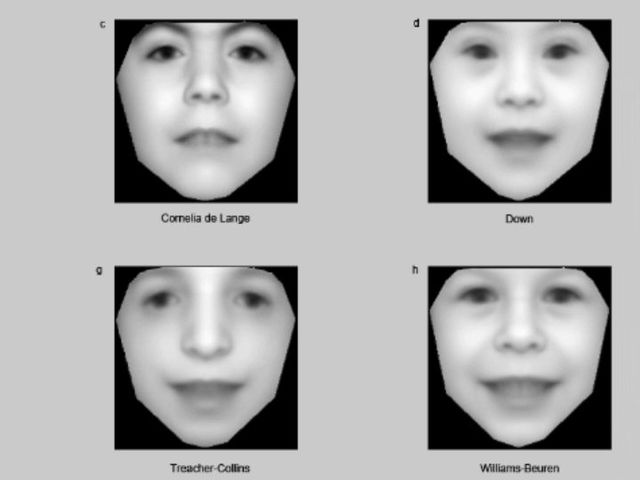 Модельное изображение лица ребёнка с редкими генетическими нарушениями: по часовой стрелке синдром Корнелии де Ланге, синдром Дауна, синдром Вильямса (синдром "лица Эльфа") и синдром Тричера Коллинза (иллюстрация Khristoffer Nellaker/University of Oxford).