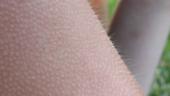 Гусиная кожа или пилоэрекция возникает при сильной эмоциональной реакции (фото Wikimedia Commons). 